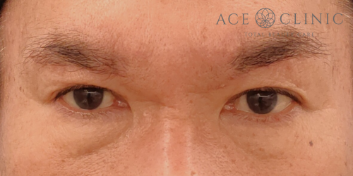 眉毛下切開法|症例64|50代男性|術後|エースクリニック名古屋院