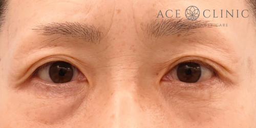 眉毛下切開法|症例63|50代女性|術前|エースクリニック名古屋院