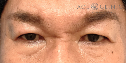眉毛下切開法|症例64|50代男性|術前|エースクリニック名古屋院