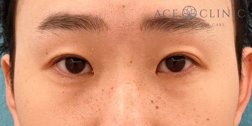 二重まぶた埋没法|症例62|20代男性|術後|エースクリニック名古屋院