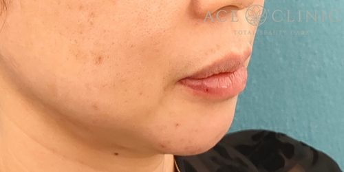 ヒアルロン酸｜症例47 ｜40代女性｜術後｜エースクリニック名古屋院