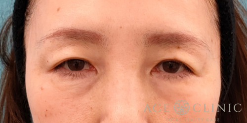 眉毛下切開｜症例65｜50代女性｜術前｜エースクリニック名古屋院