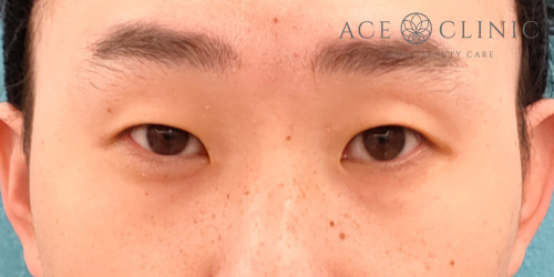 二重まぶた埋没法|症例62|20代男性|術前|エースクリニック名古屋院