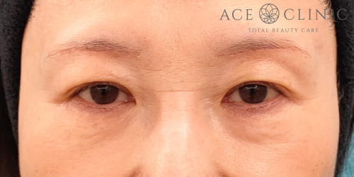 眉毛下切開|症例66|50代女性|術前|エースクリニック名古屋院