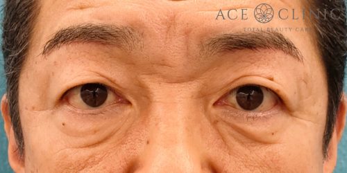 眉毛下切開｜症例69｜50代男性｜術後｜エースクリニック名古屋院