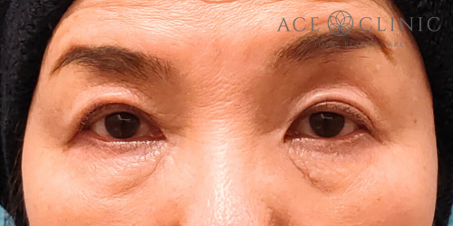 眼瞼挙筋前転法|症例92|60代女性|術後|エースクリニック名古屋院