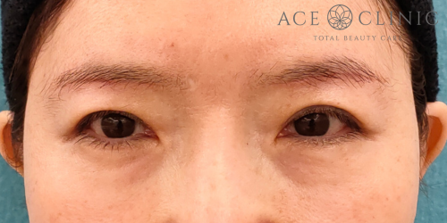 眉毛下切開|症例68|60代女性|術後|エースクリニック名古屋院