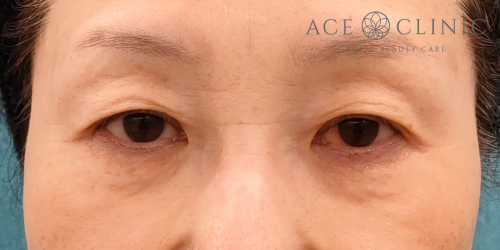 眉毛下切開|症例66|50代女性|術前|エースクリニック名古屋院