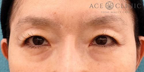 眉毛下切開|症例68|60代女性|術前|エースクリニック名古屋院
