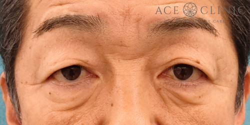 眉毛下切開｜症例69｜50代男性｜術前｜エースクリニック名古屋院