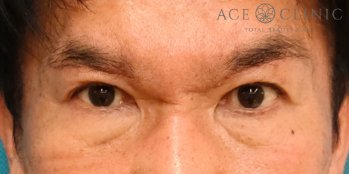 眉毛下切開法｜症例74｜60代男性｜術前後3ヶ月｜エースクリニック名古屋院