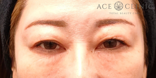 眉毛下切開法｜症例71｜50代女性｜術後3ヶ月 ｜エースクリニック名古屋院