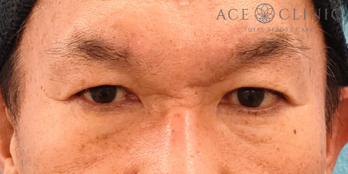眉毛下切開法｜症例74｜60代男性｜術前 ｜エースクリニック名古屋院
