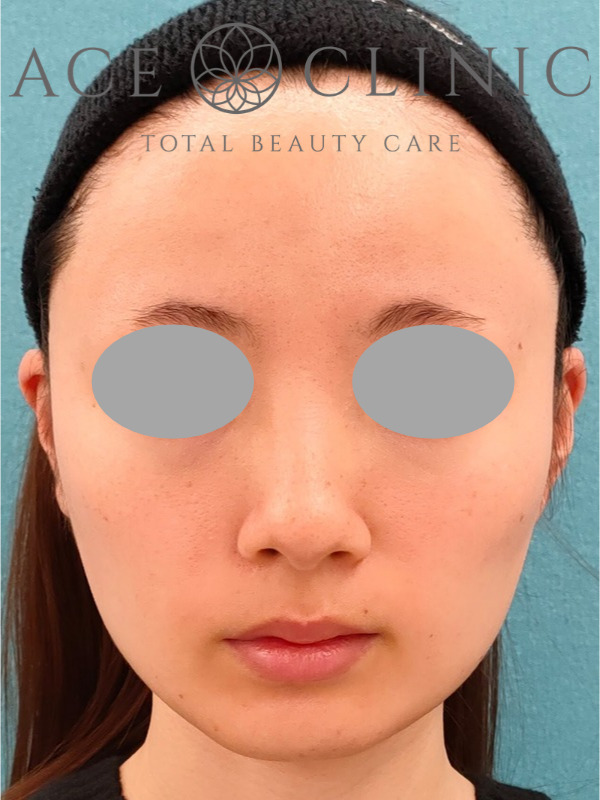 エラ(咬筋)ボツリヌストキシン注射|CASE9|25歳女性|施術後2ヶ月|正面