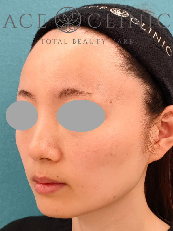 エラ（咬筋）ボツリヌストキシン注射｜CASE9｜25歳女性｜施術後2ヶ月｜左斜め