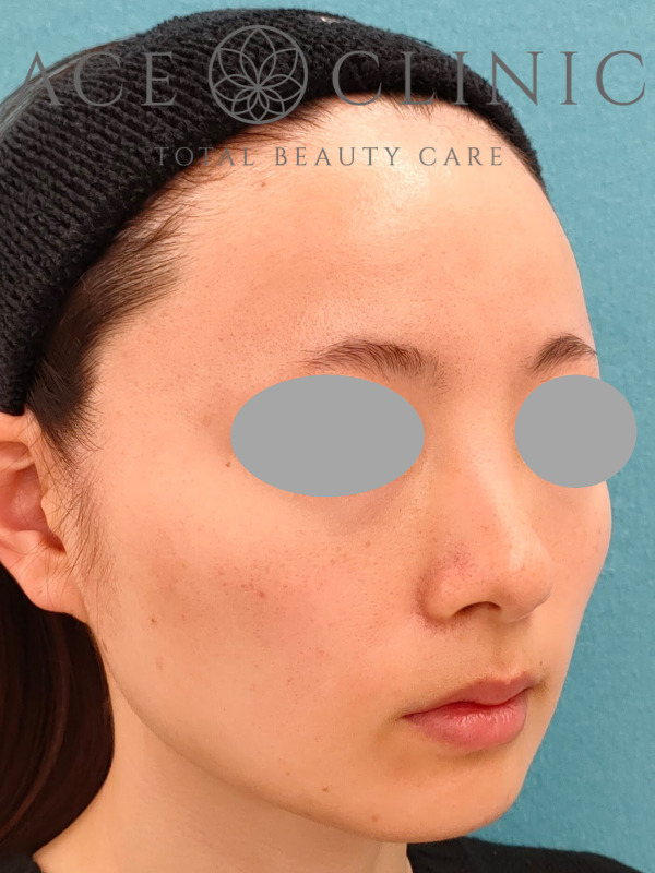 エラ（咬筋）ボツリヌストキシン注射｜CASE9｜25歳女性｜施術後2ヶ月｜右斜め
