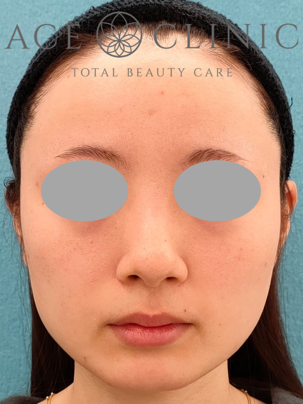 エラ(咬筋)ボツリヌストキシン注射|CASE9|25歳女性|施術前|正面