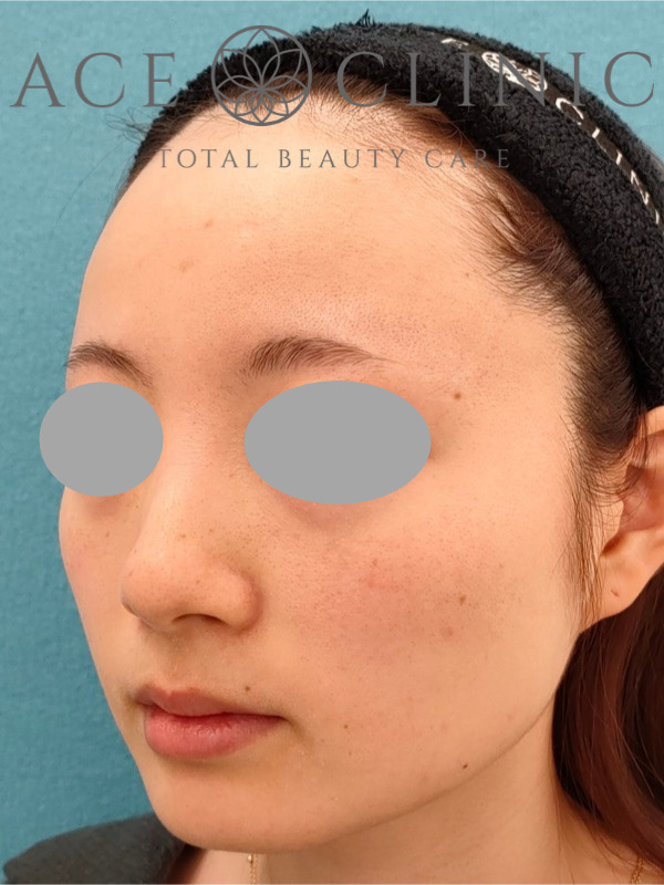 エラ（咬筋）ボツリヌストキシン注射｜CASE9｜25歳女性｜施術前｜左斜め