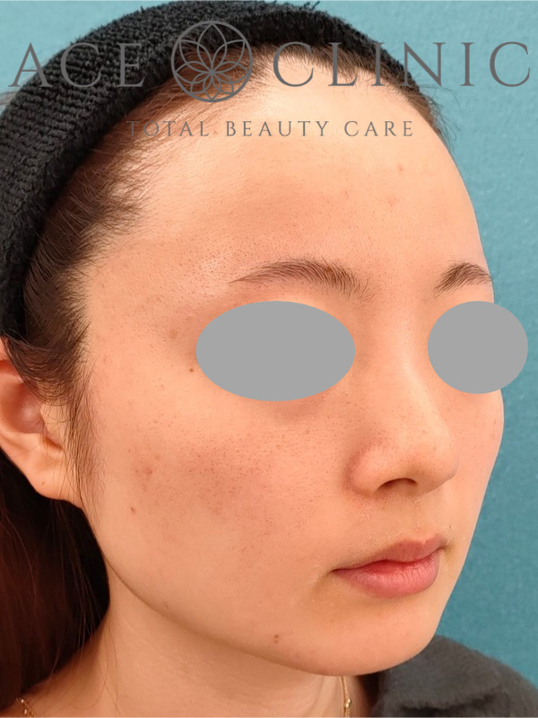 エラ（咬筋）ボツリヌストキシン注射｜CASE9｜25歳女性｜施術前｜右斜め
